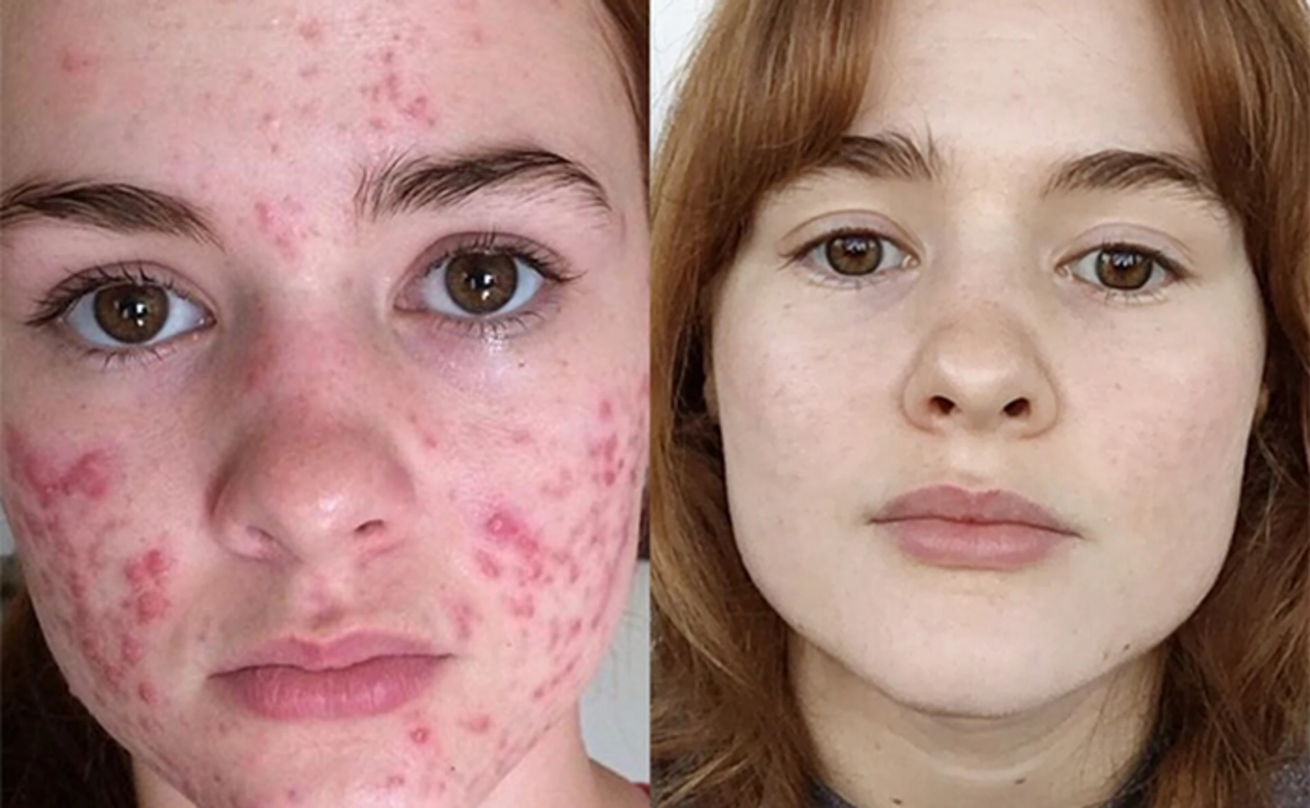 Kali Kuschner Akne Vorher Nachher