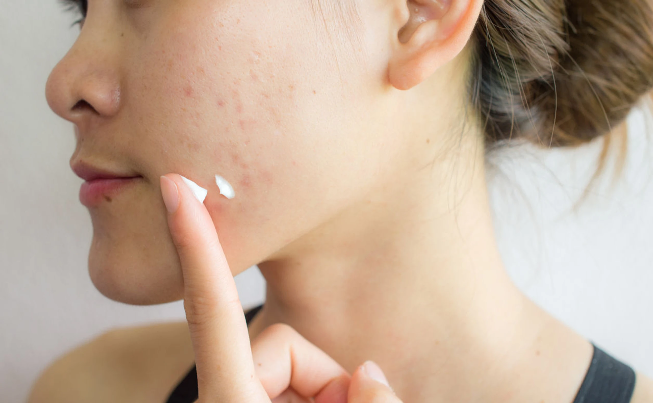 Erfahrungsbericht: So habe ich meine Erwachsenenakne in den Griff bekommen