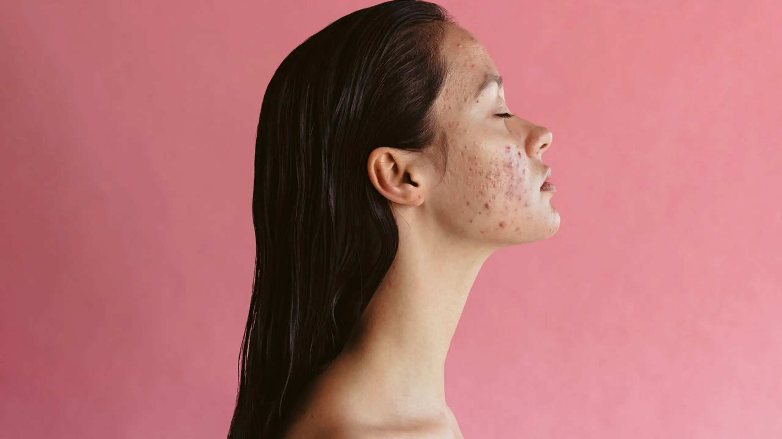 Pickelmale: So wirst du Pickenarben wieder los