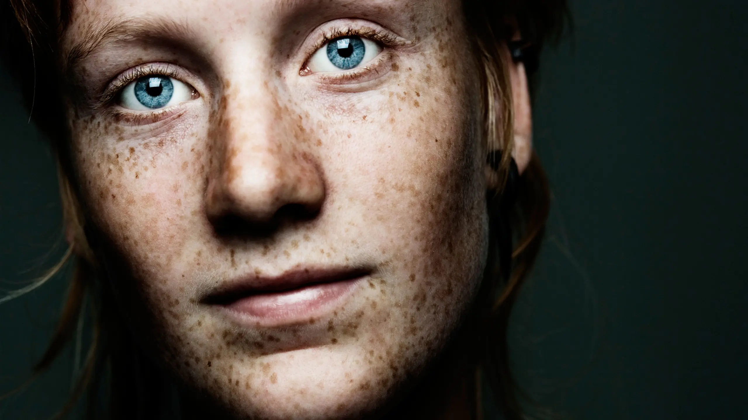 Pigmentflecken im Gesicht: So wurde ich sie (beinahe) los!