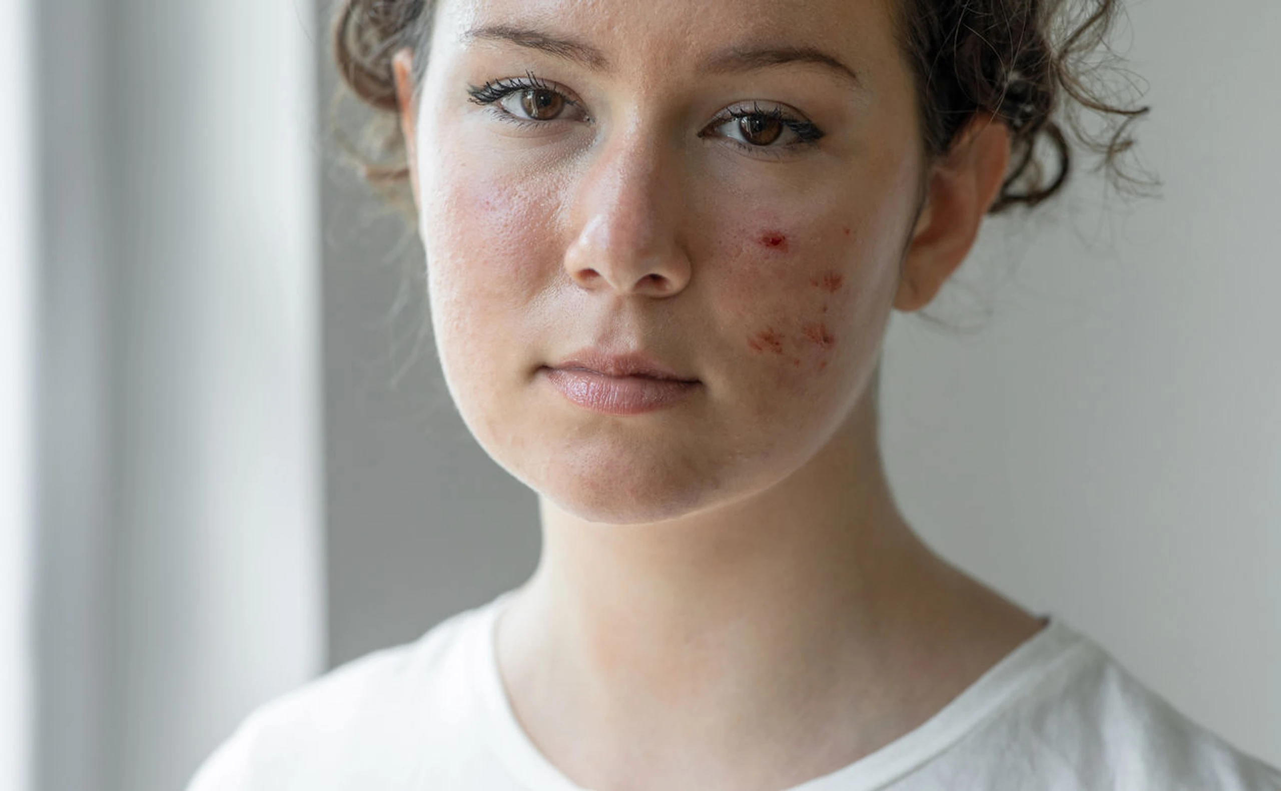 Rosacea: Was steckt hinter der Hauterkrankung?