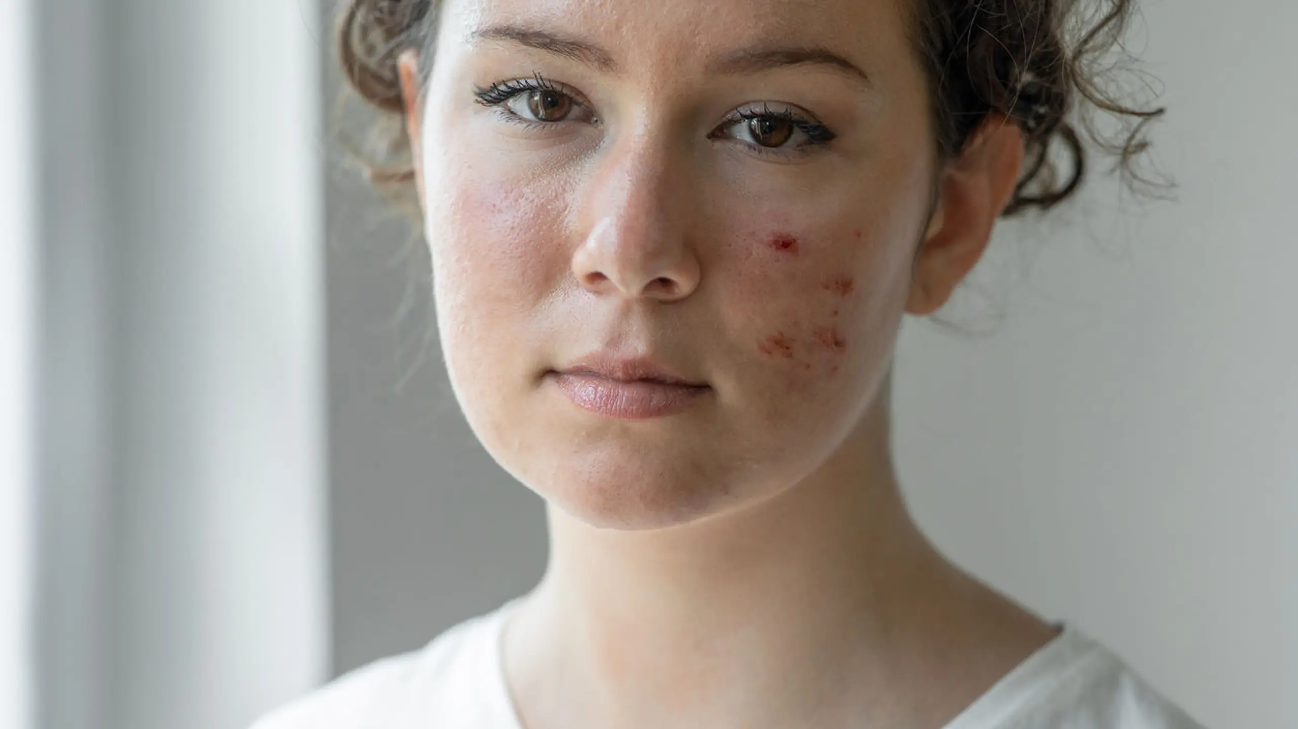 Rosacea: Was steckt hinter der Hauterkrankung?