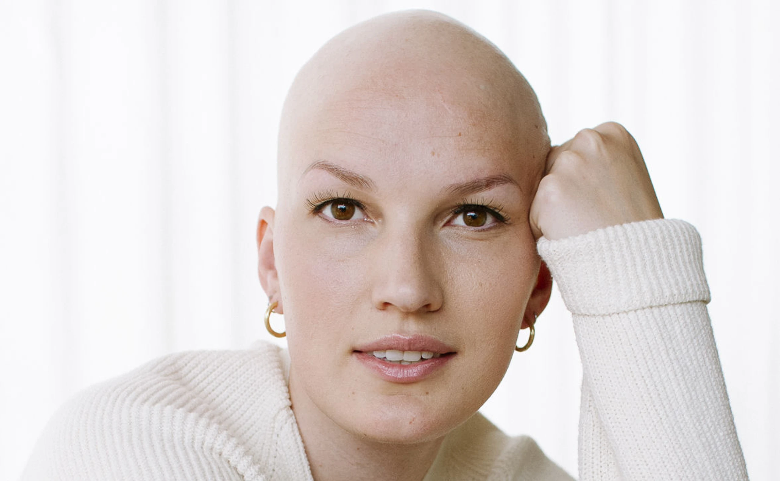 glatze, alopezie, haare, keine haare, krankheit,