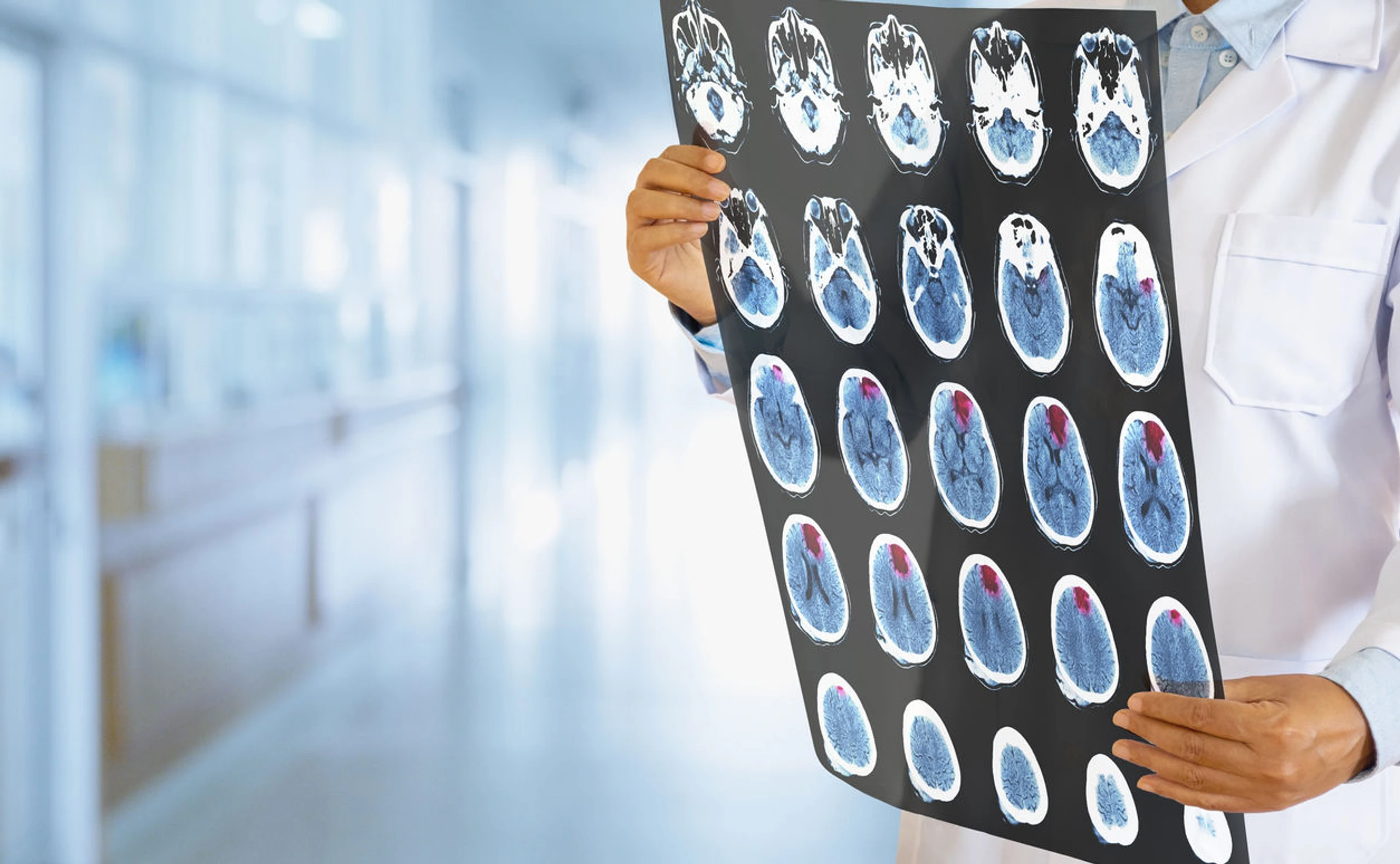 Schlaganfall bei Frauen erkennen: Ursachen, Symptome und Erste Hilfe