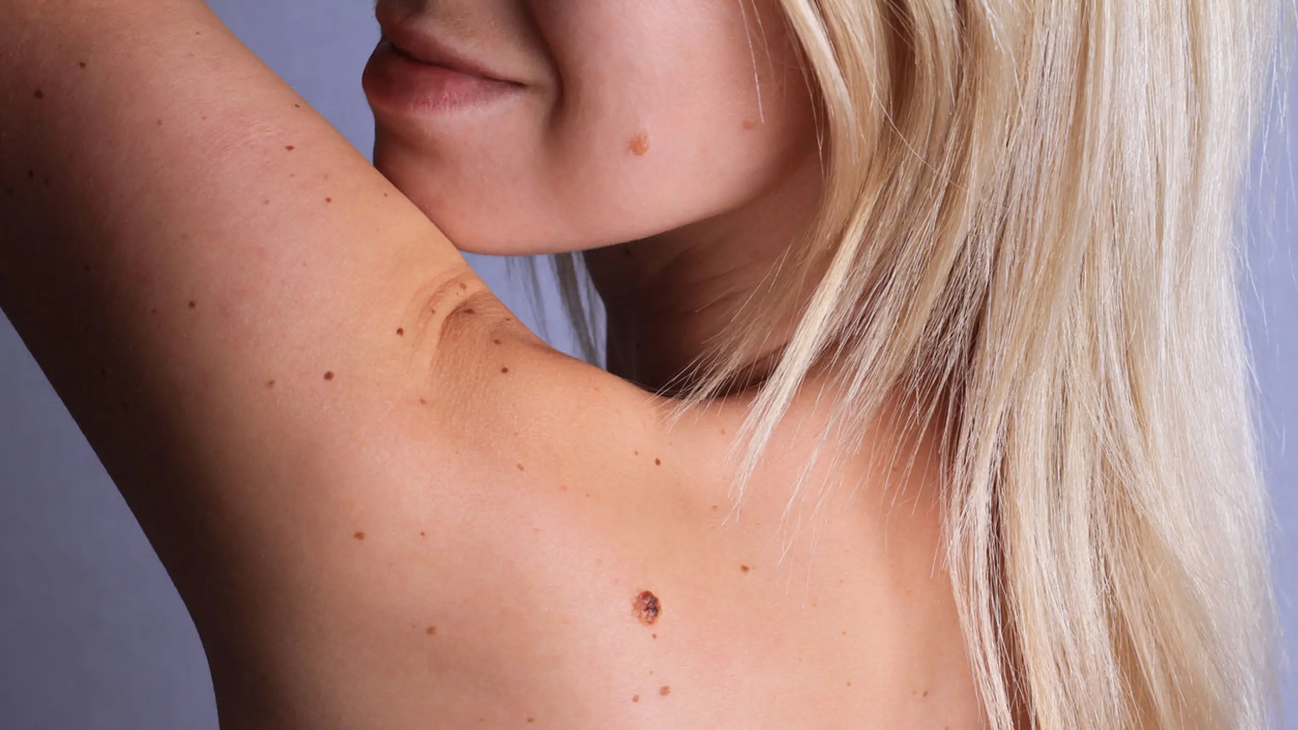 Hautkrebs selber erkennen