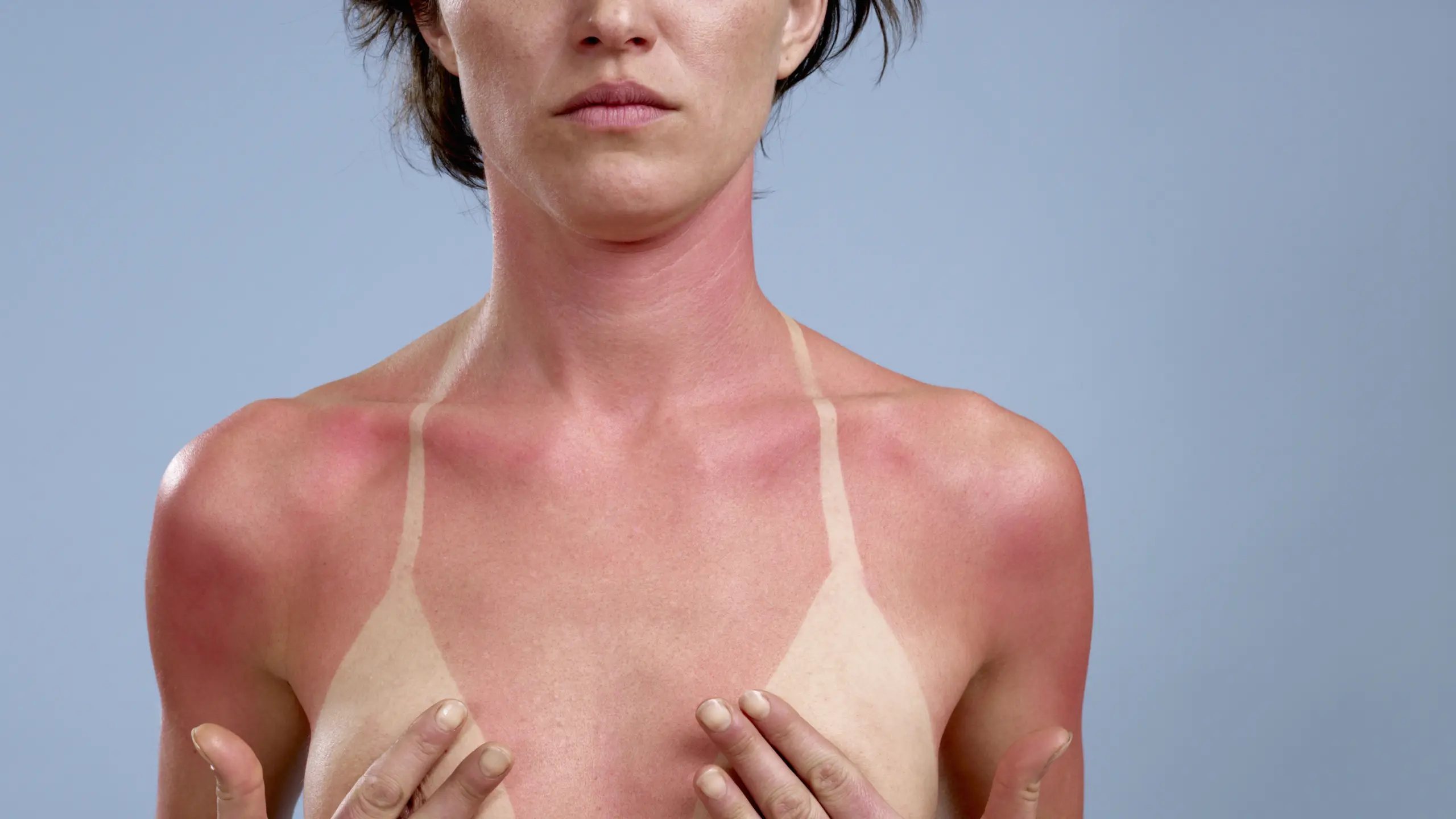 Sonnenflecken: Was tun gegen Melasma auf Haut und Gesicht?