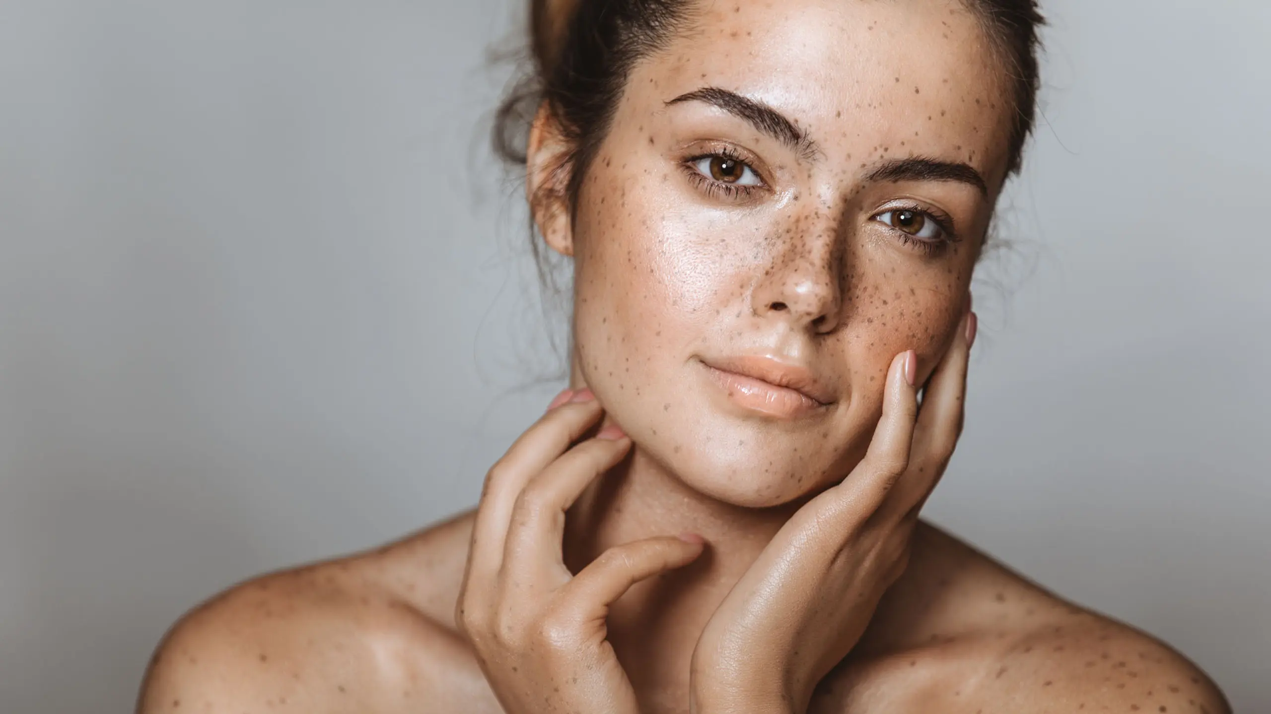 pigmentflecken-sommersprossen