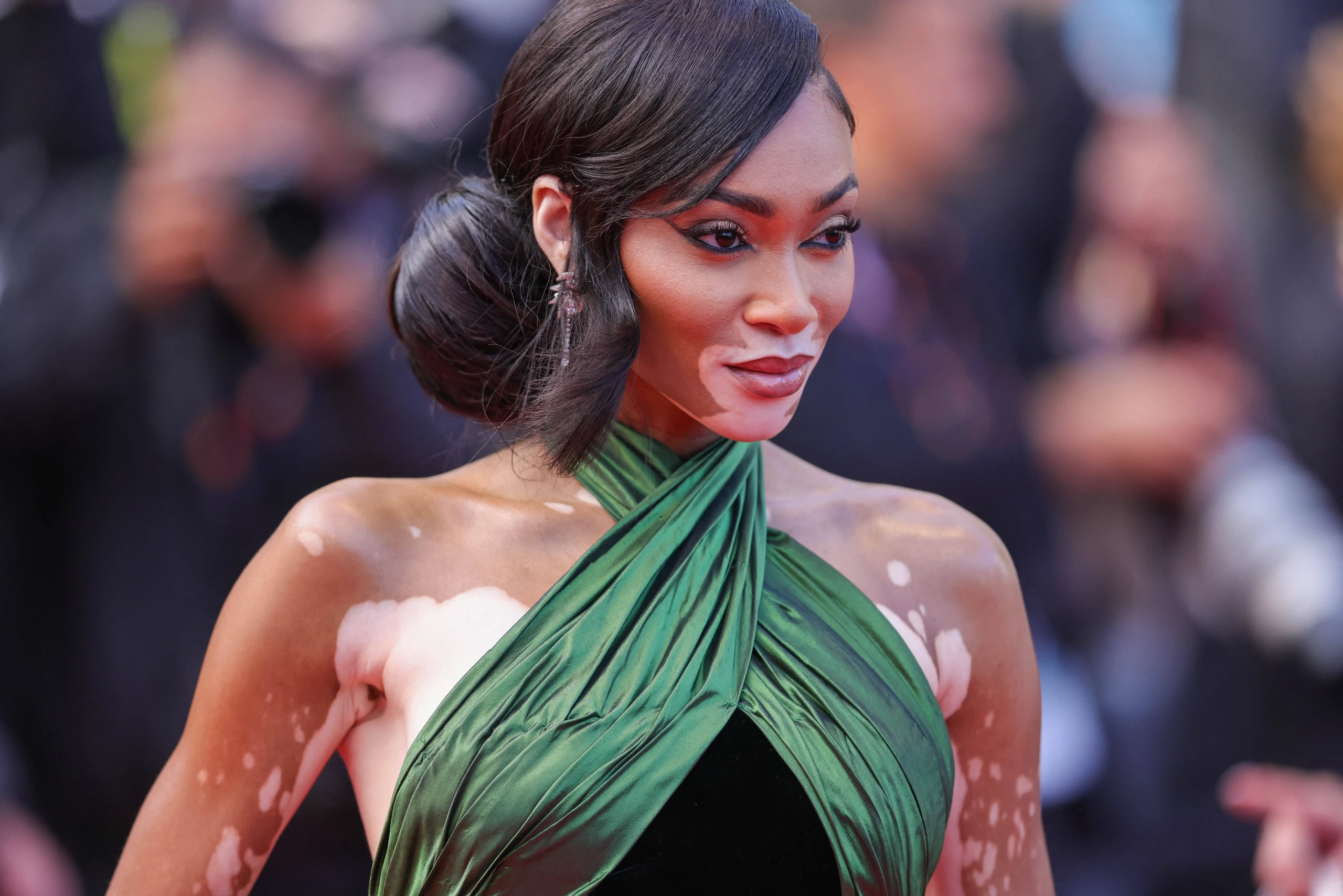 Vitiligo: Die Weißfleckenkrankheit ist eine seltene Pigmentstörung