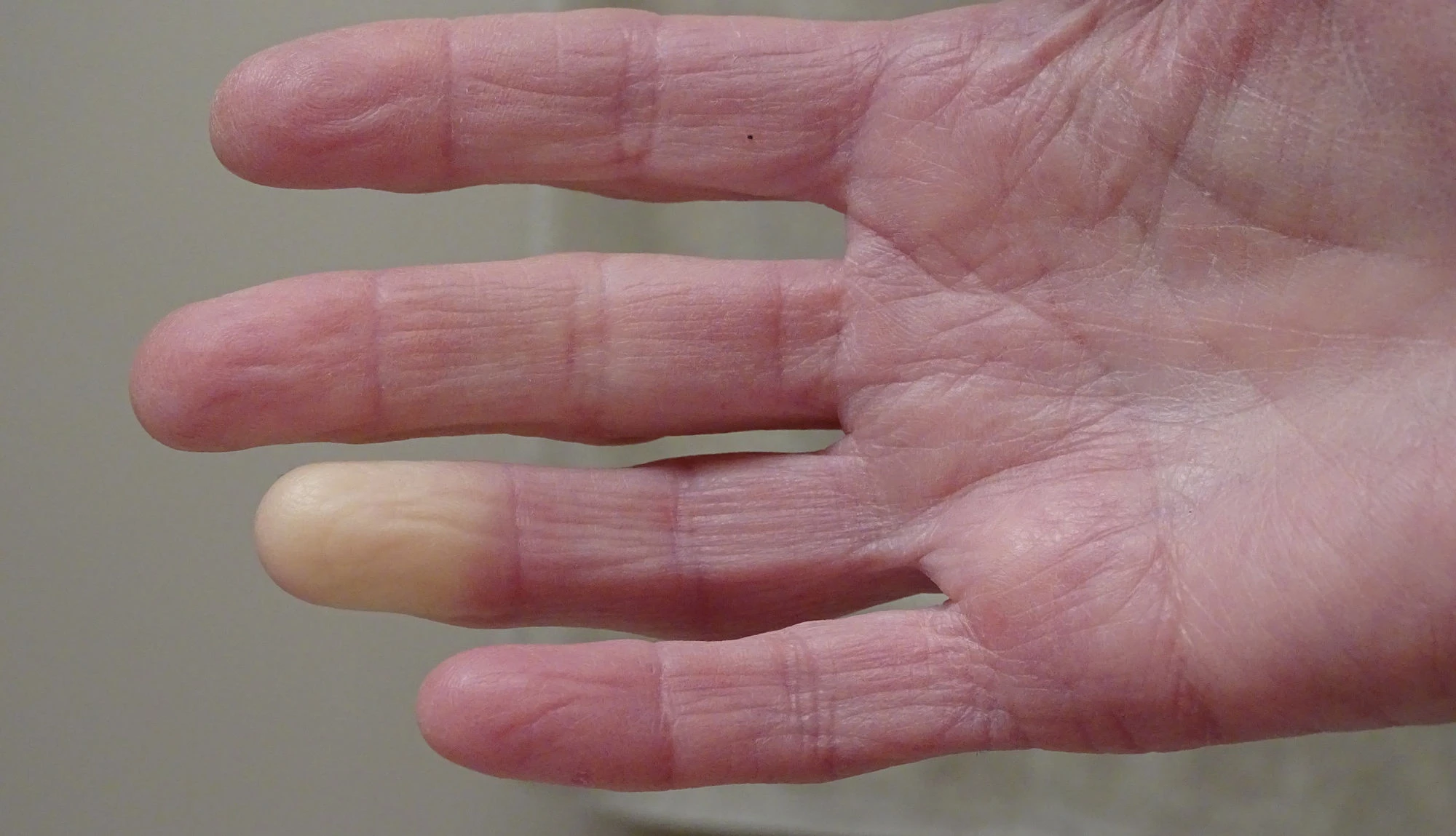 Raynaud-Syndrom