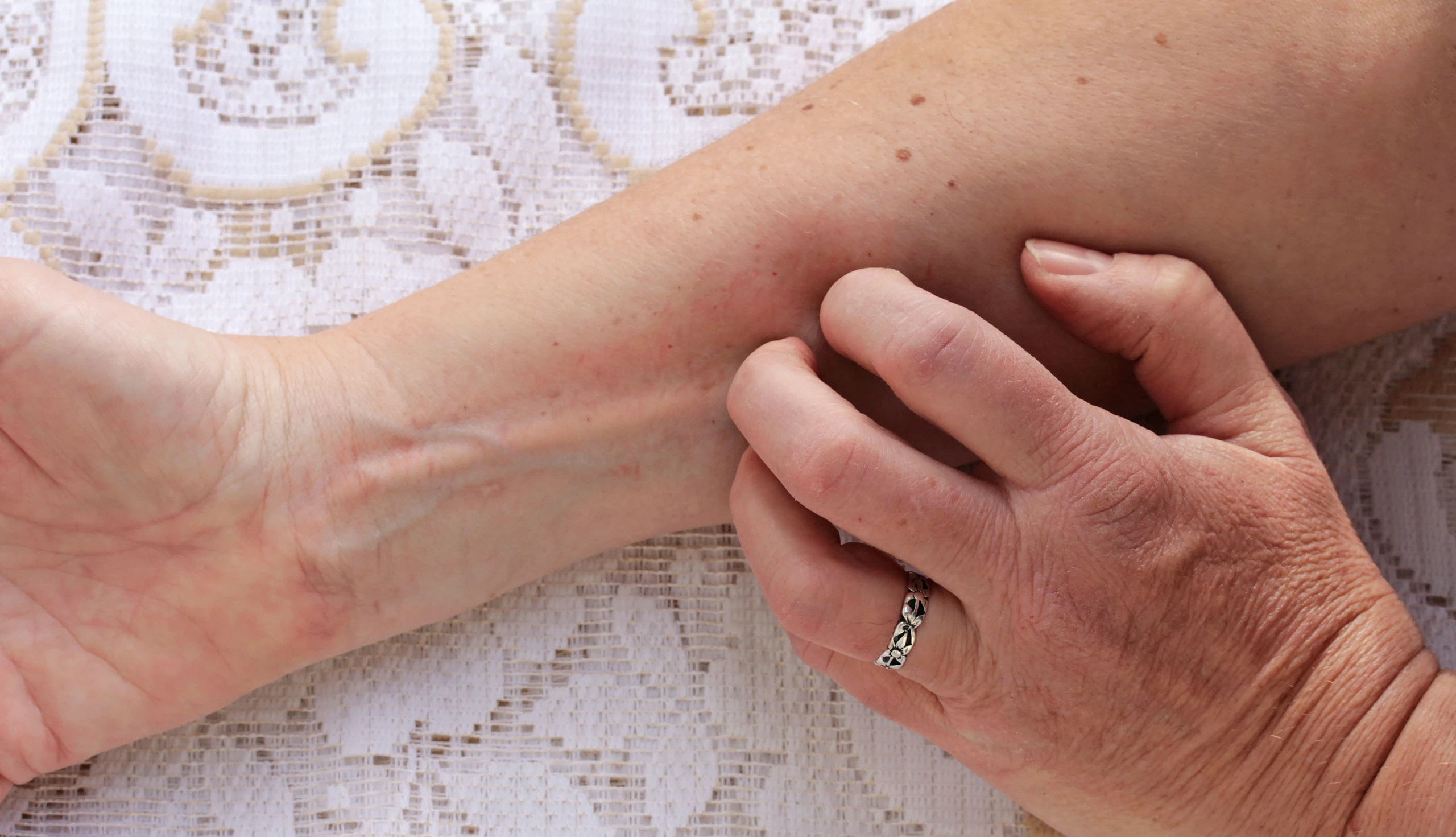 Gesundheit - Neurodermitis: Was hilft bei der atopischen Dermatitis?