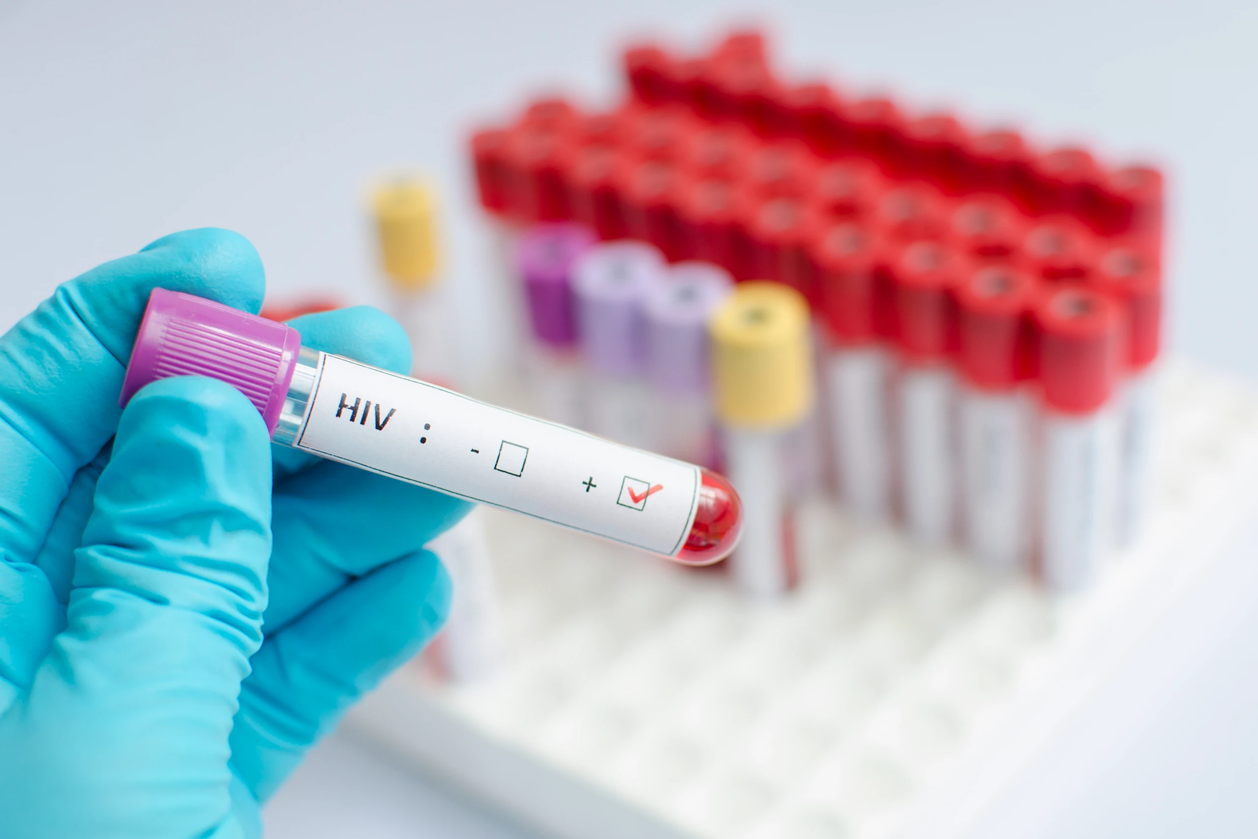 HIV