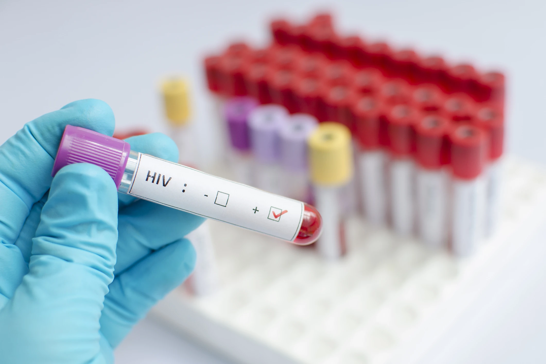 HIV