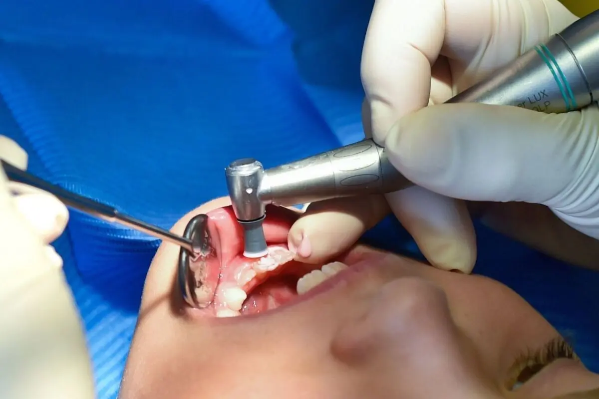 Zahnfüllungen ohne Amalgam sorgen für Streit
