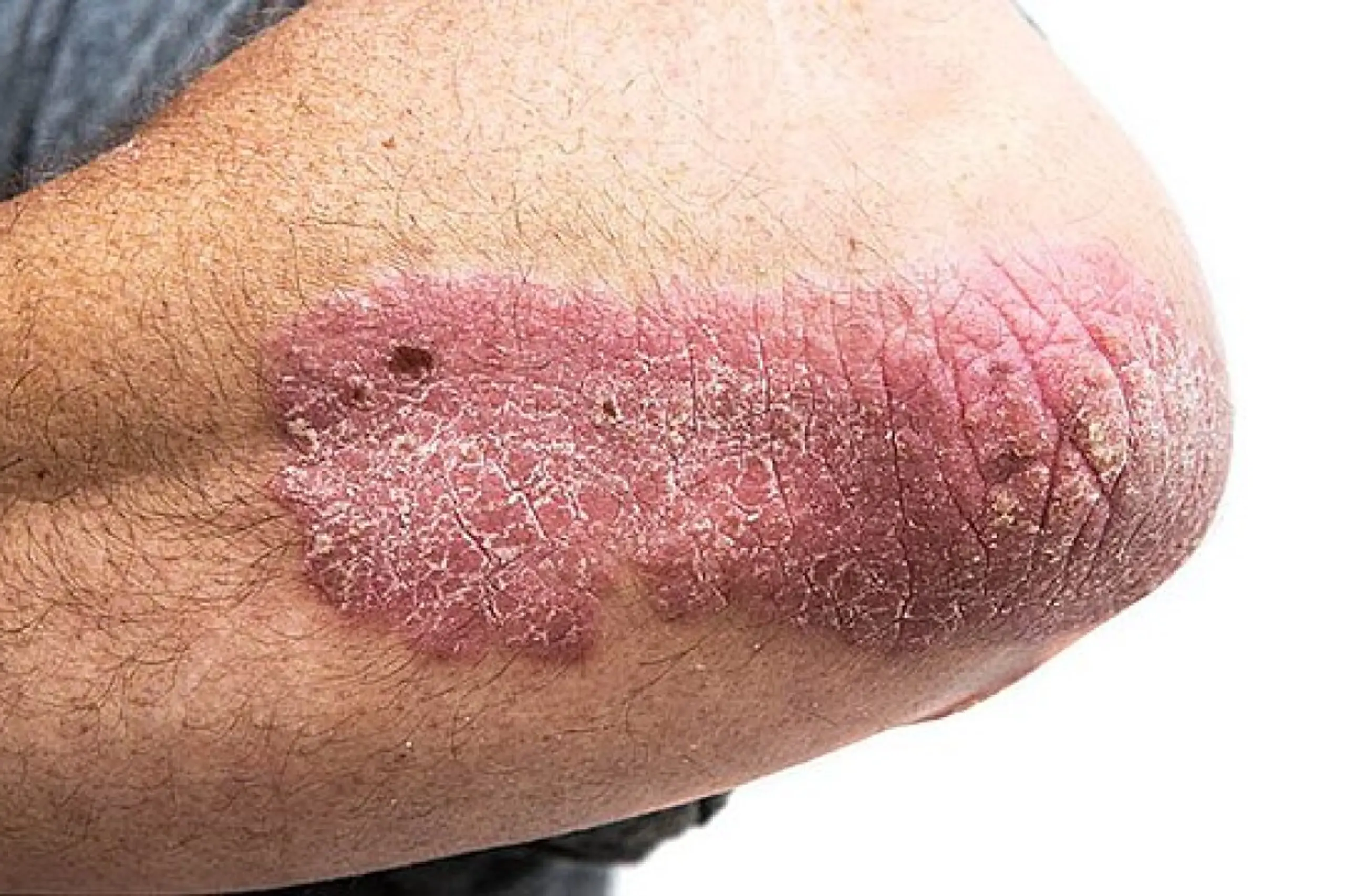 Rund 250.000 Menschen in Österreich von Psoriasis betroffen