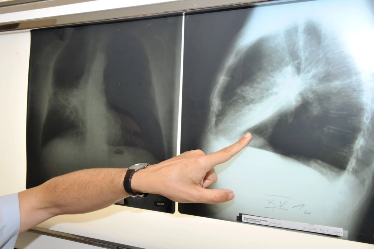 Ersatz von Chemotherapie?