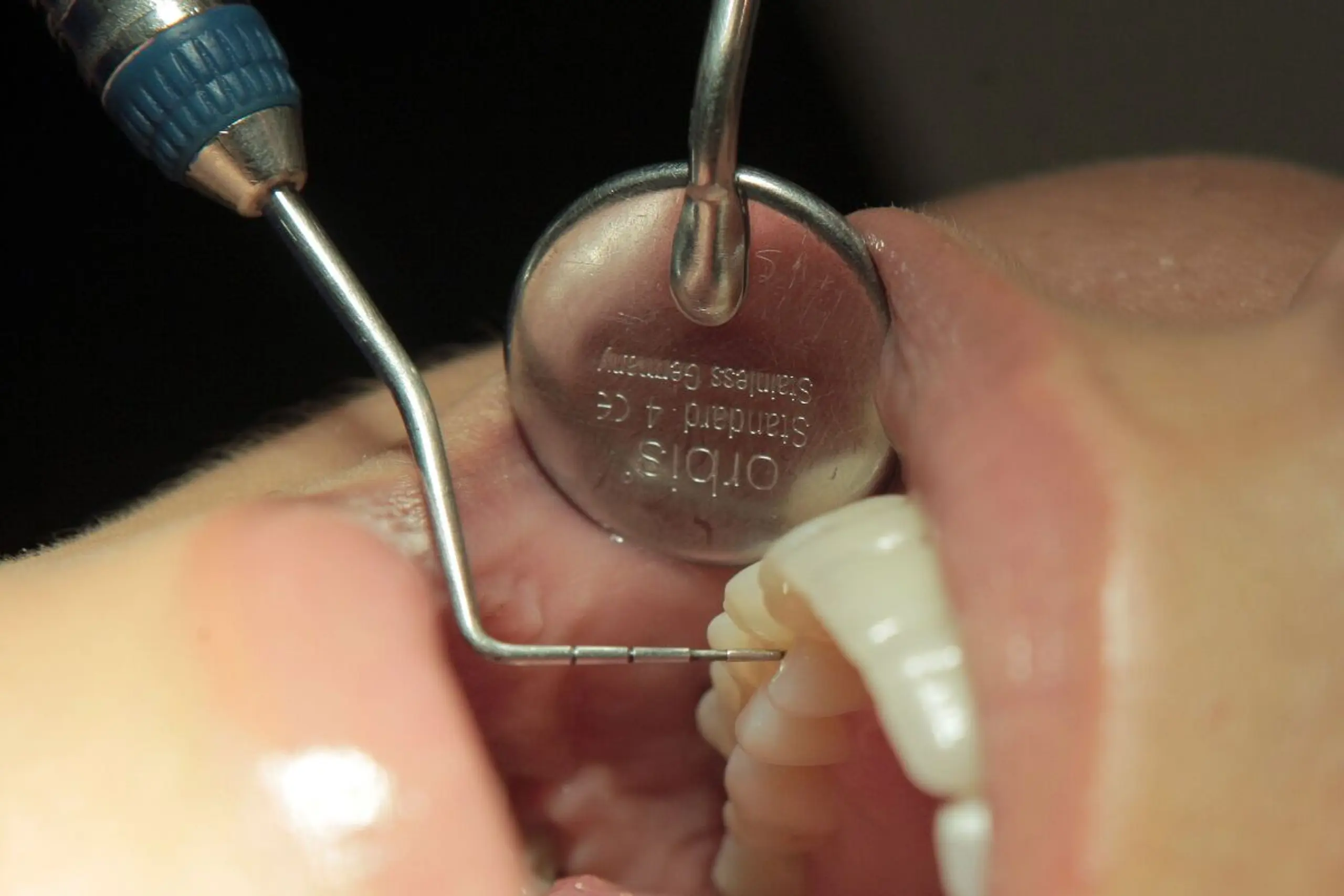 Zusammenführung von zwei Operationstechniken brachte Fortschritte