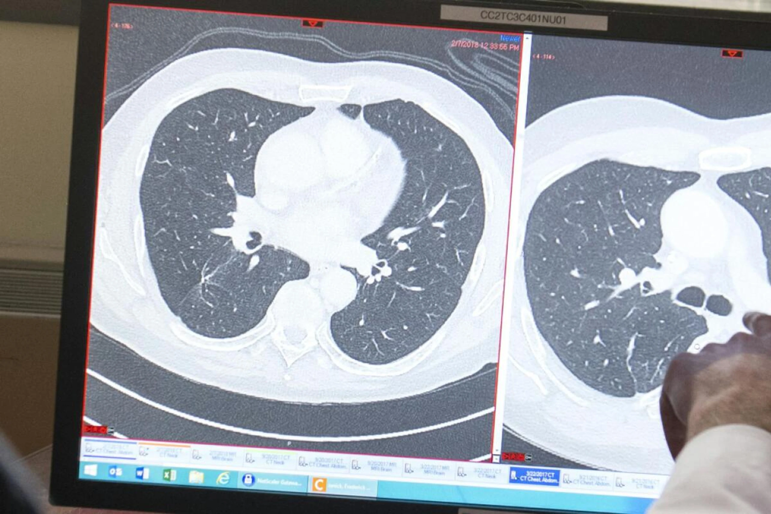 Blick auf einen Tumor