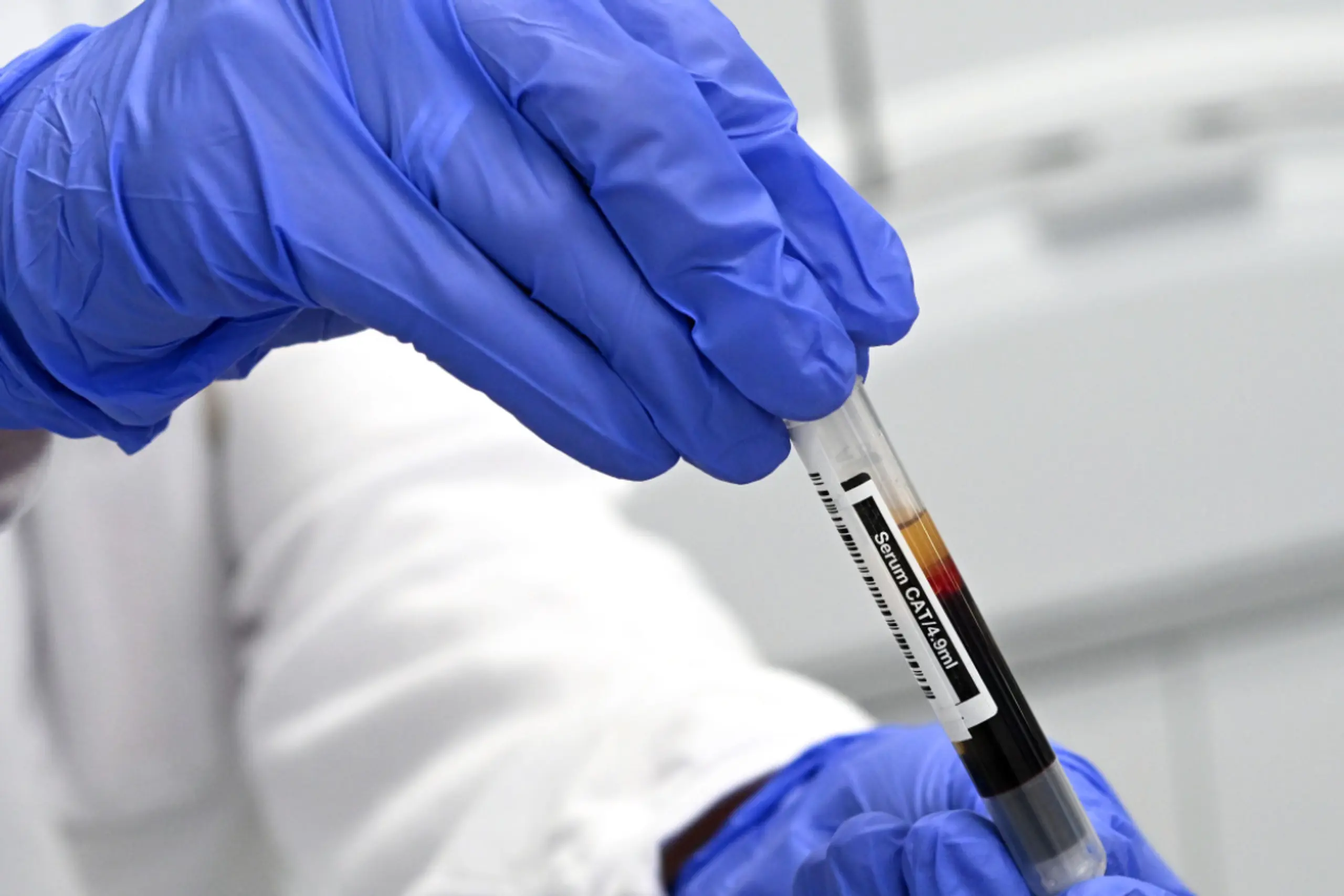 Eisenmangel wird durch eine Blutuntersuchung festgestellt