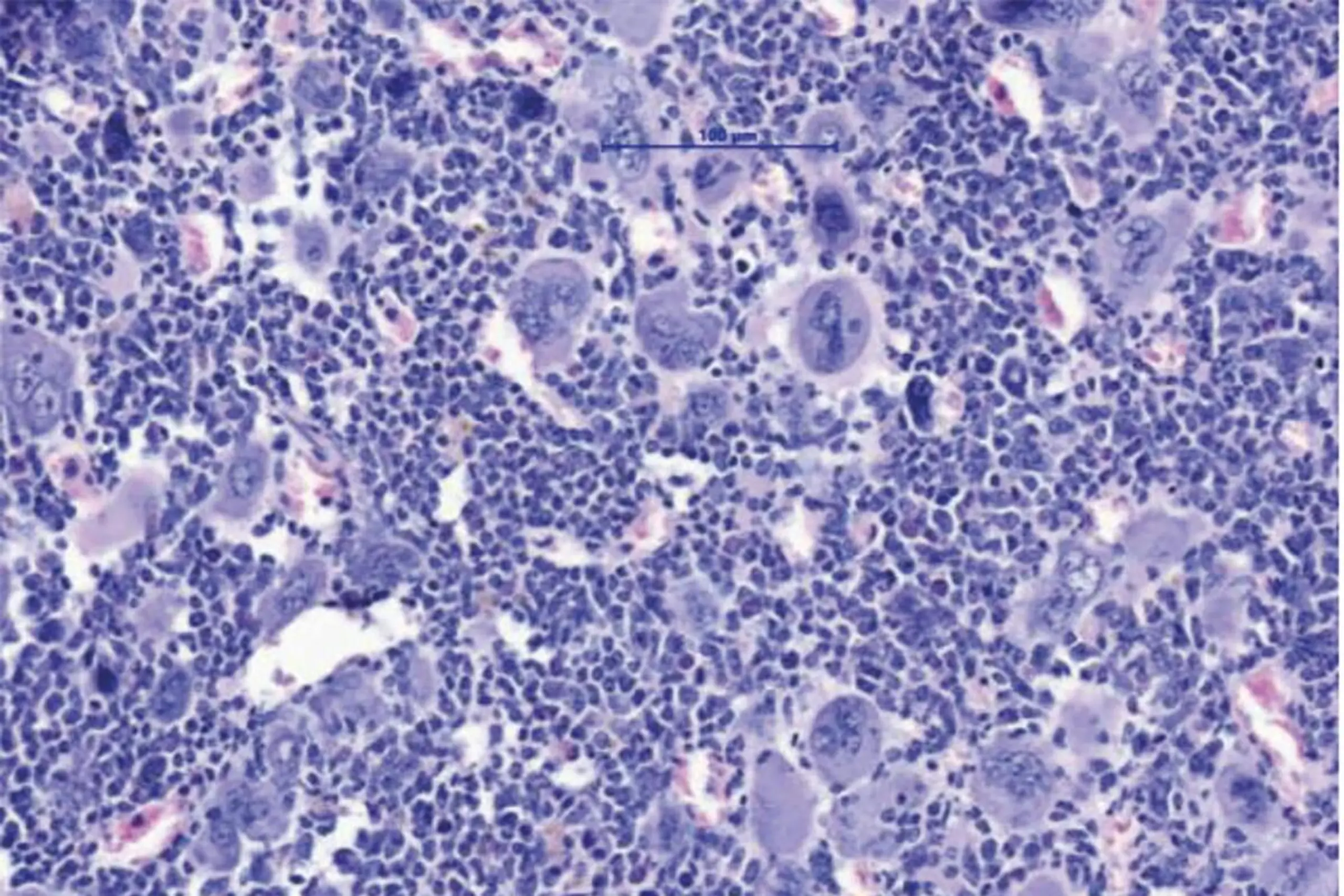MPN sind durch eine Expansion des blutbildenden Systems im Knochenmark charakterisiert. Dies führt zum Anstieg verschiedener Zellreihen und im Endzustand dann zur Knochenmarksvernarbung und auch akuten Leukämie