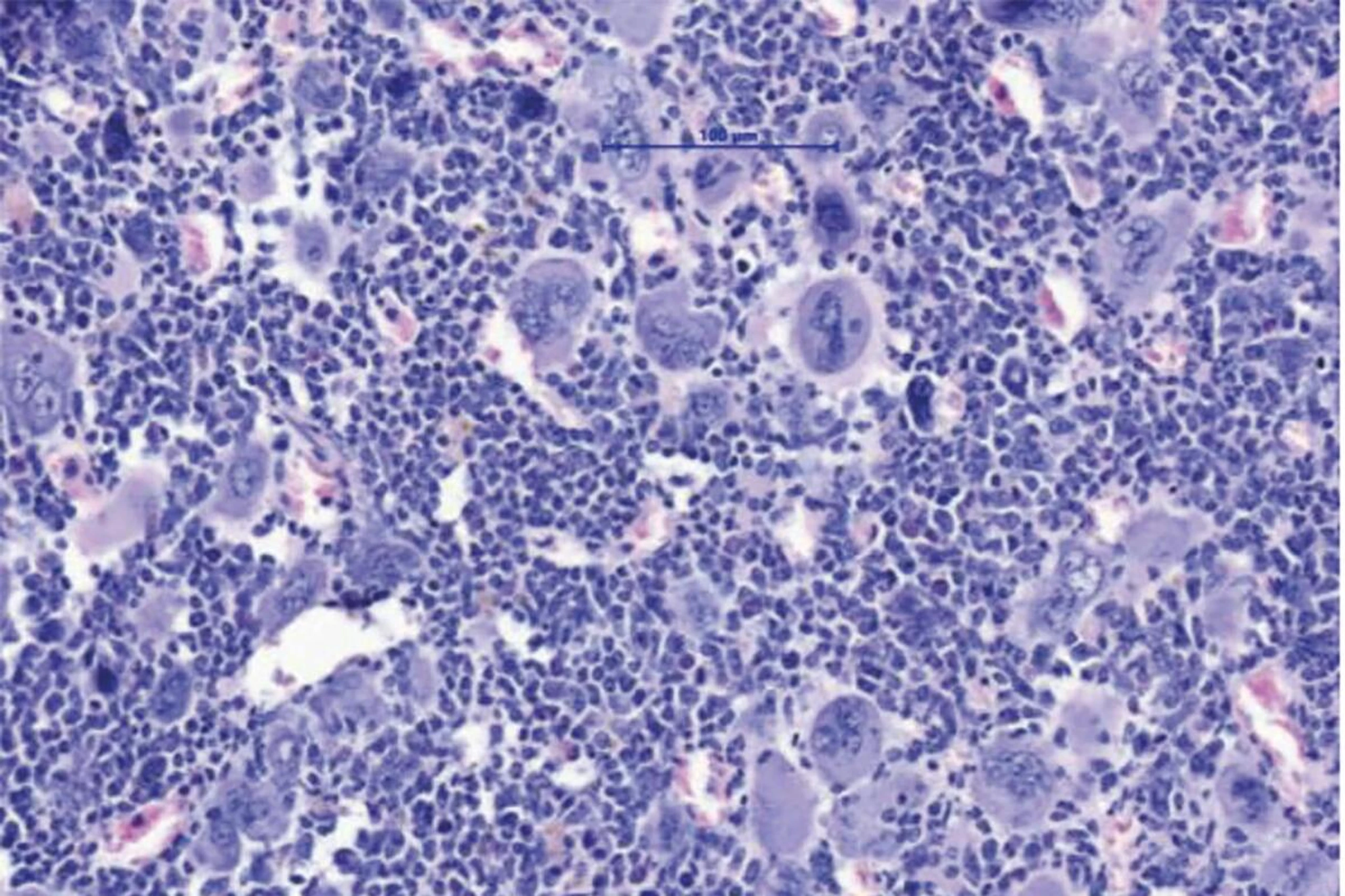 MPN sind durch eine Expansion des blutbildenden Systems im Knochenmark charakterisiert. Dies führt zum Anstieg verschiedener Zellreihen und im Endzustand dann zur Knochenmarksvernarbung und auch akuten Leukämie