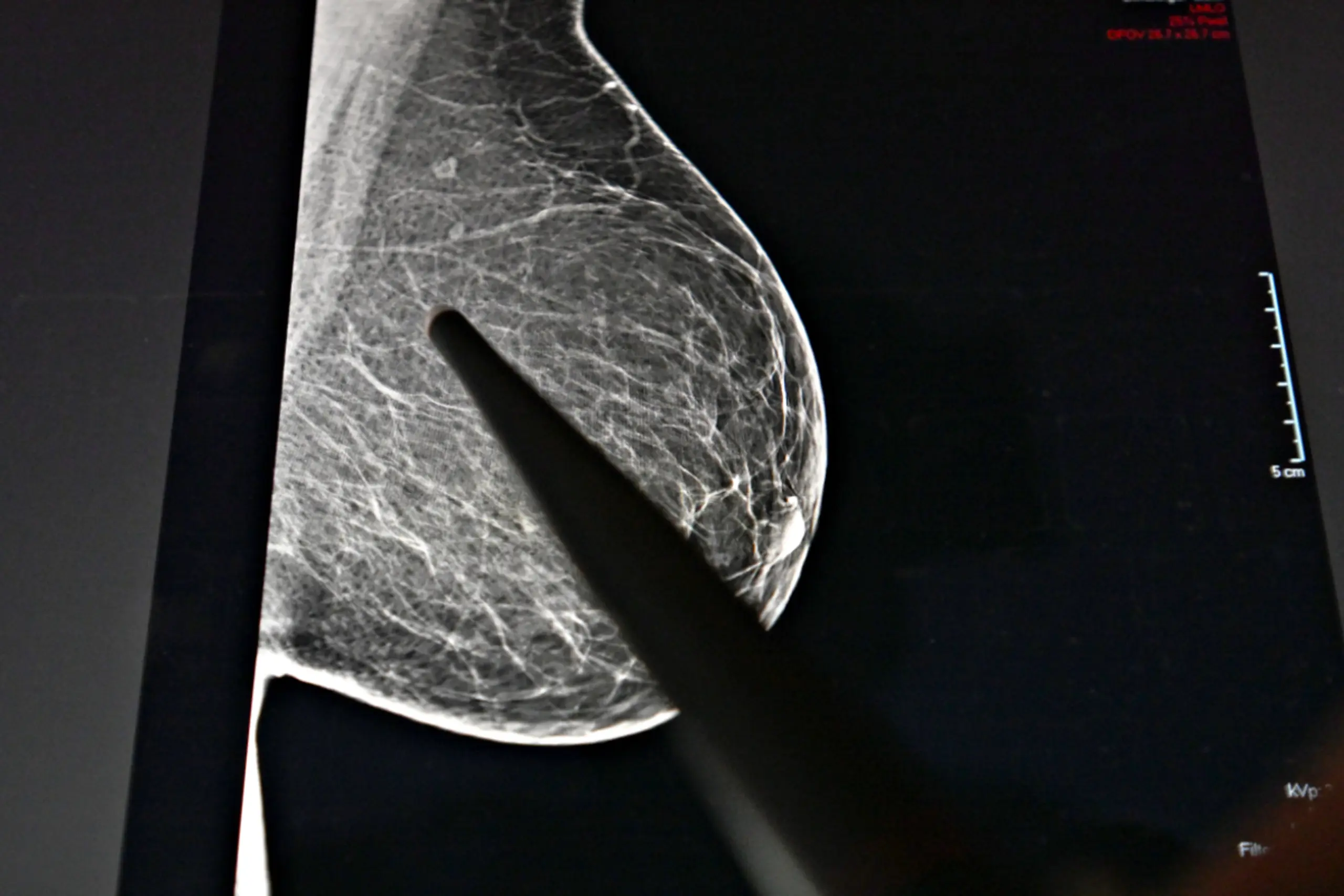 Häufigste Diagnose bei Frauen war Brustkrebs