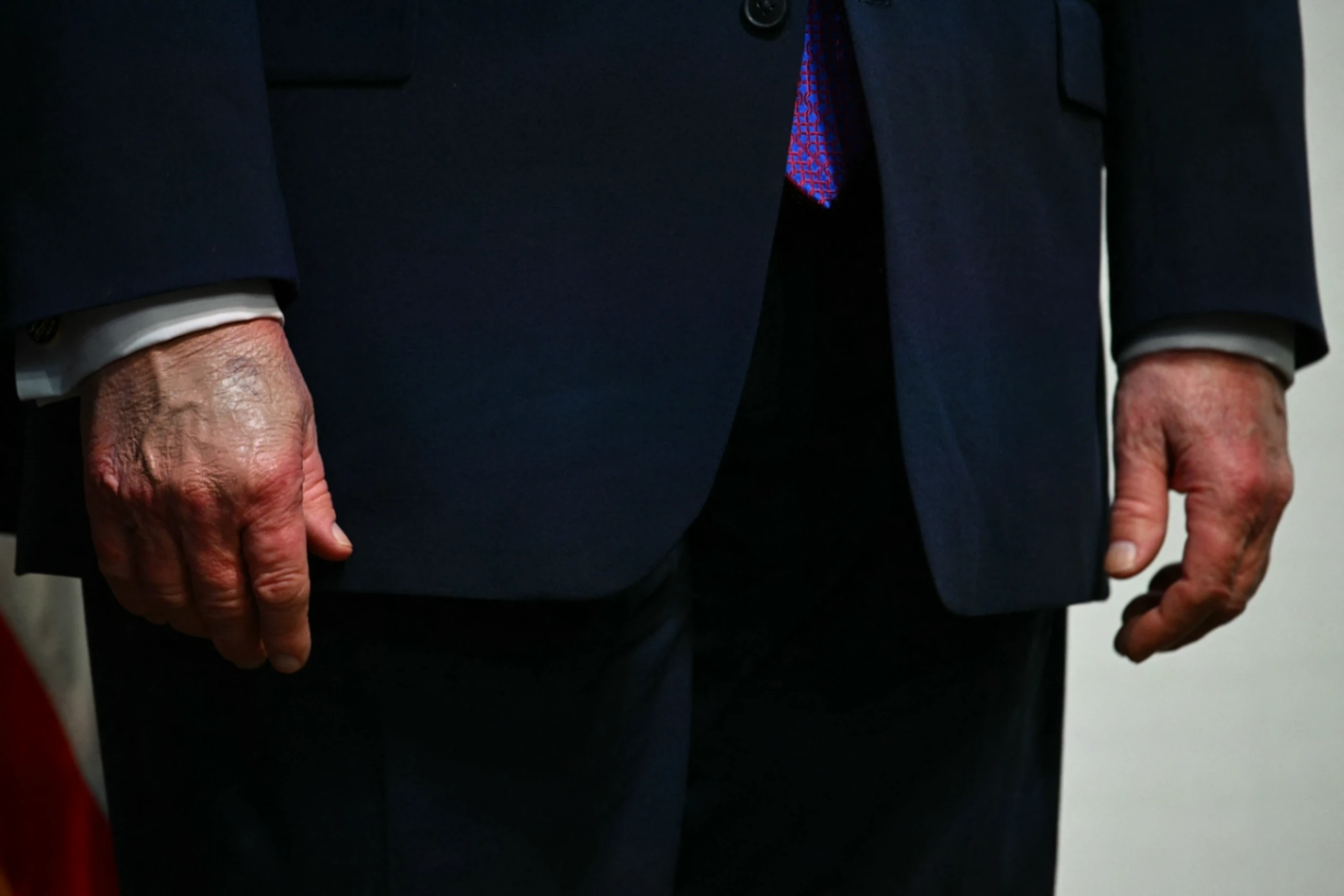 Die Hände Trumps sorgten für Fragen über dessen Gesundheitszustand