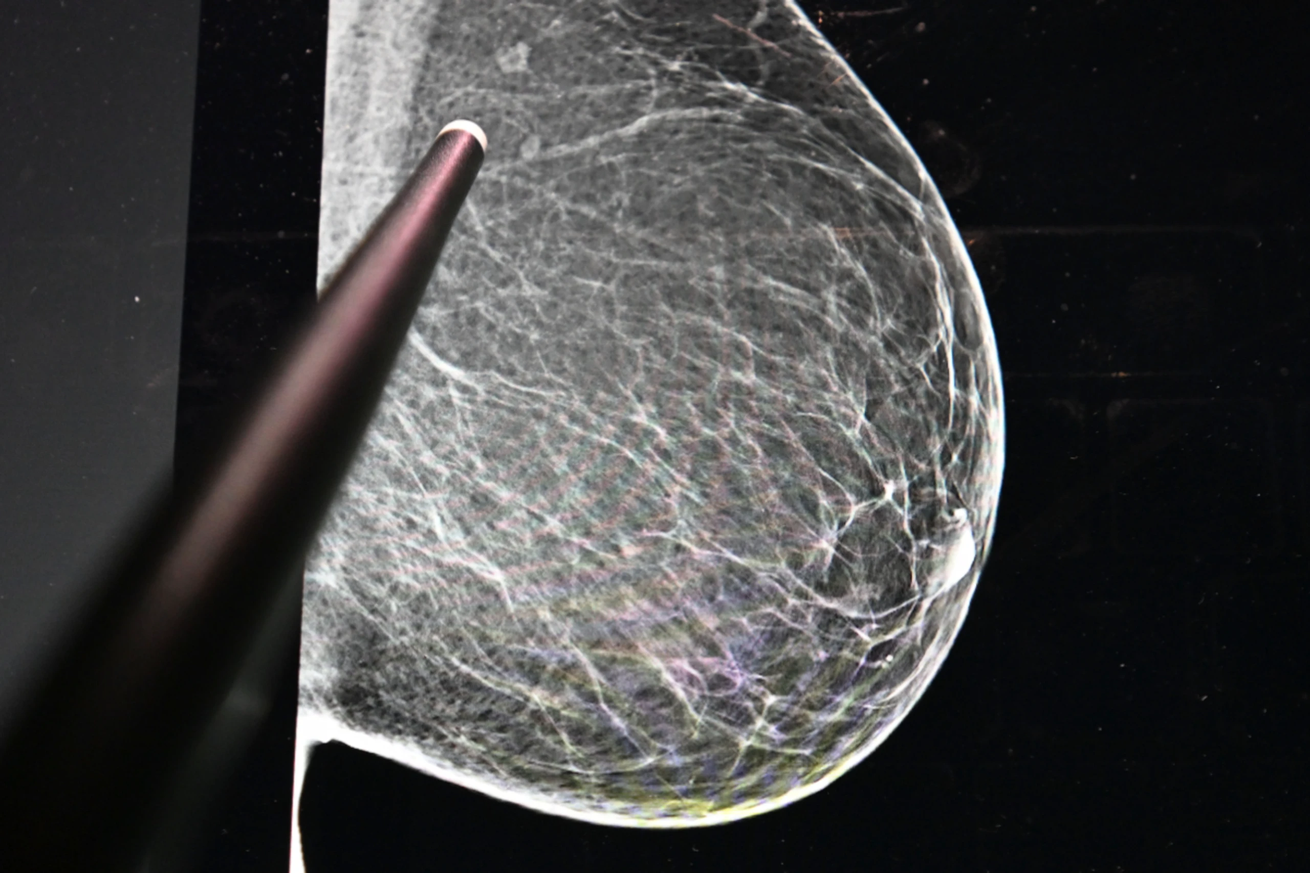 Mammografie